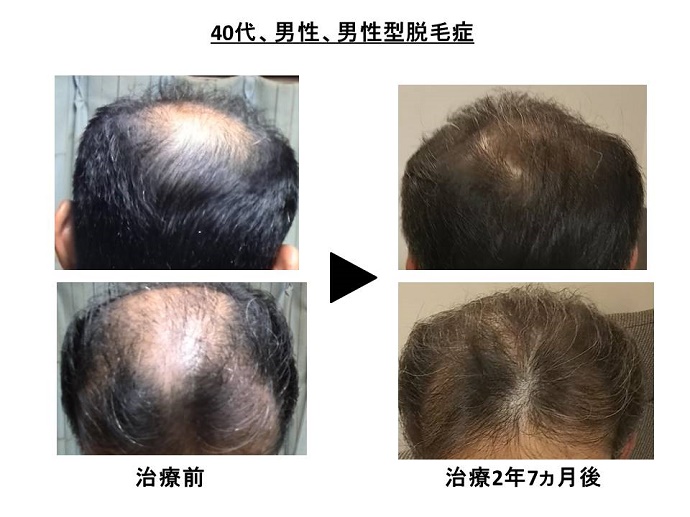 円形脱毛症　病院